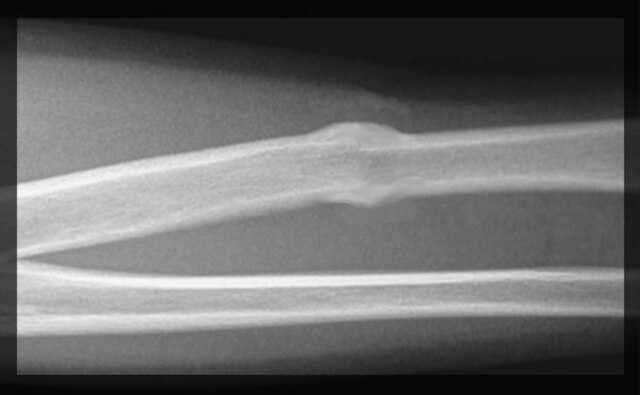 Kallus (Medizin) Wikiwand