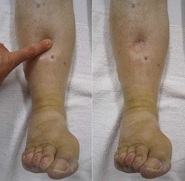 Edema - Wikiwand