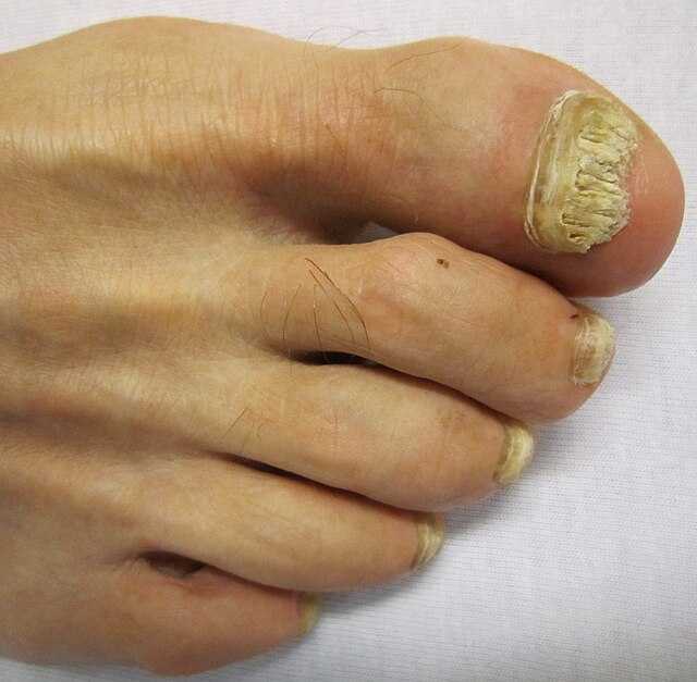 Onychomycosis - Wikiwand