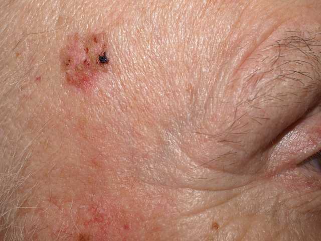 Morbus Bowen - Wikiwand